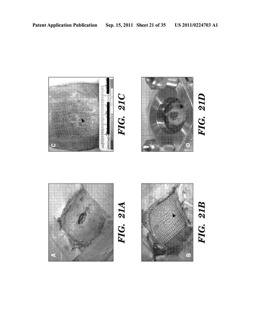 PROSTHETIC DEVICE HAVING DIAGONAL YARNS AND METHOD OF MANUFACTURING THE     SAME - diagram, schematic, and image 22