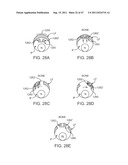 METHODS, SYSTEMS AND DEVICES FOR CARPAL TUNNEL RELEASE diagram and image