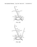 METHODS, SYSTEMS AND DEVICES FOR CARPAL TUNNEL RELEASE diagram and image