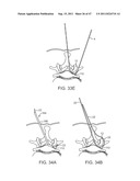 METHODS, SYSTEMS AND DEVICES FOR CARPAL TUNNEL RELEASE diagram and image