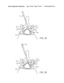 METHODS, SYSTEMS AND DEVICES FOR CARPAL TUNNEL RELEASE diagram and image