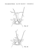 METHODS, SYSTEMS AND DEVICES FOR CARPAL TUNNEL RELEASE diagram and image