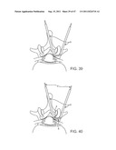 METHODS, SYSTEMS AND DEVICES FOR CARPAL TUNNEL RELEASE diagram and image