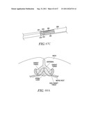 METHODS, SYSTEMS AND DEVICES FOR CARPAL TUNNEL RELEASE diagram and image