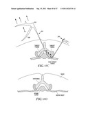 METHODS, SYSTEMS AND DEVICES FOR CARPAL TUNNEL RELEASE diagram and image