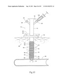 Universal Introducer diagram and image