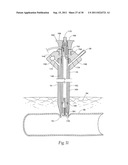 Universal Introducer diagram and image