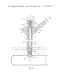 Universal Introducer diagram and image