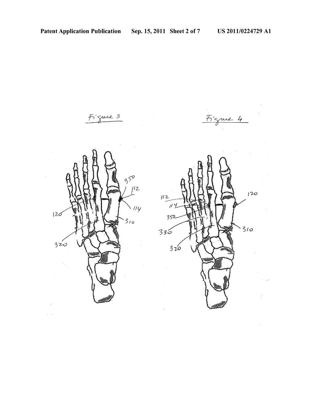 HALLUX VALGUS REPAIRS USING SUTURE-BUTTON CONSTRUCT - diagram, schematic, and image 03