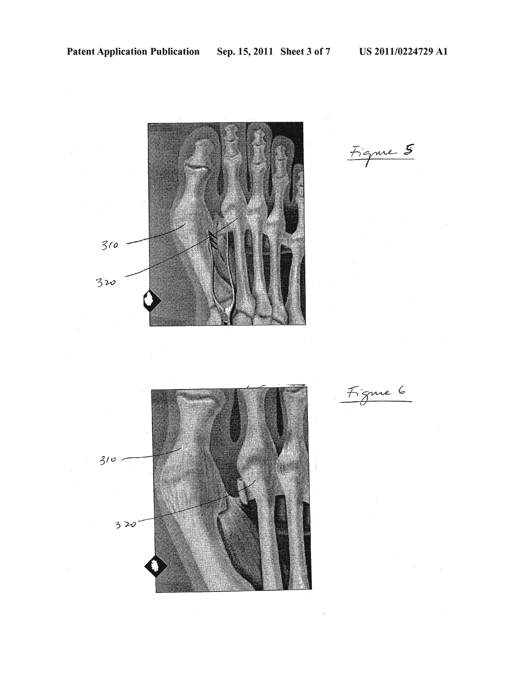 HALLUX VALGUS REPAIRS USING SUTURE-BUTTON CONSTRUCT - diagram, schematic, and image 04