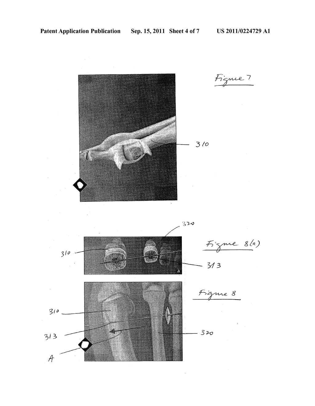 HALLUX VALGUS REPAIRS USING SUTURE-BUTTON CONSTRUCT - diagram, schematic, and image 05