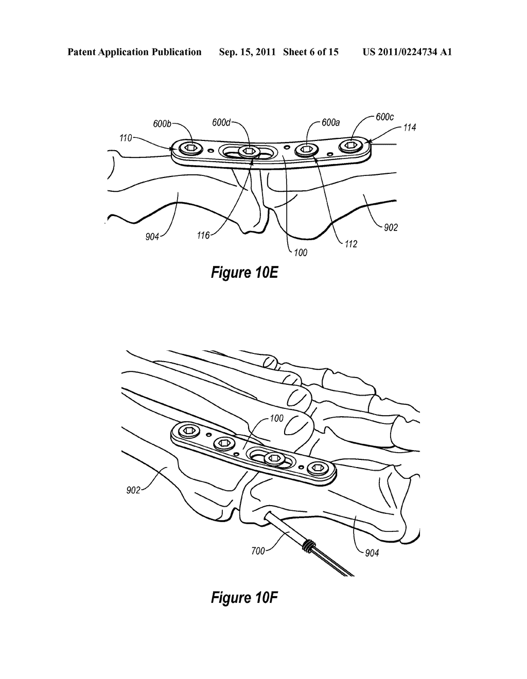 COMPRESSION PLATE KIT AND METHODS FOR REPAIRING BONE DISCONTINUITIES - diagram, schematic, and image 07