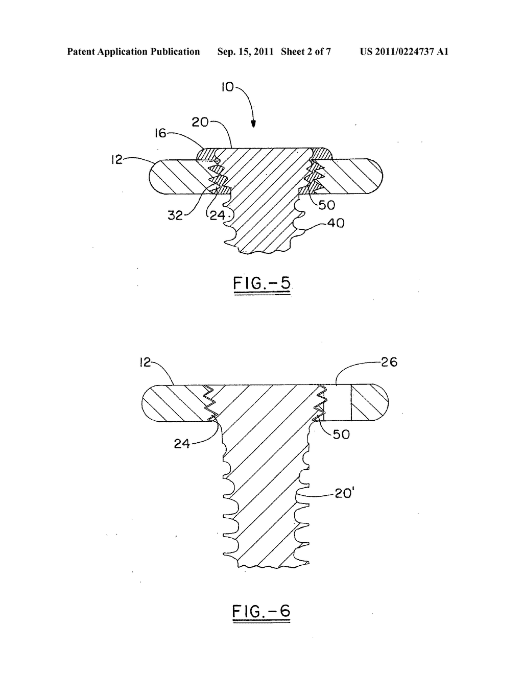 System for achieving selectable fixation in an orthopedic plate - diagram, schematic, and image 03