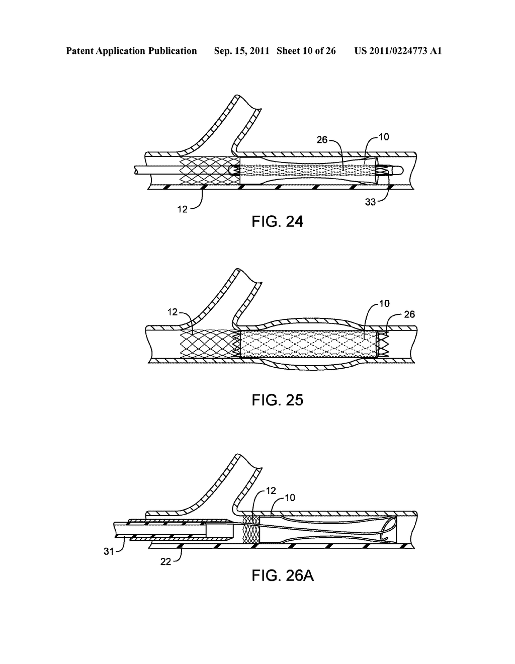 METHODS AND DEVICES FOR PROTECTING A PASSAGEWAY IN A BODY WHEN ADVANCING     DEVICES THROUGH THE PASSAGEWAY - diagram, schematic, and image 11