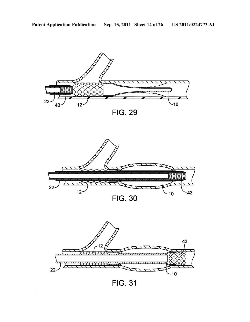 METHODS AND DEVICES FOR PROTECTING A PASSAGEWAY IN A BODY WHEN ADVANCING     DEVICES THROUGH THE PASSAGEWAY - diagram, schematic, and image 15