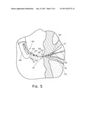 Stent Geometry diagram and image