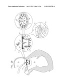 PROSTHETIC MITRAL VALVE WITH TISSUE ANCHORS diagram and image