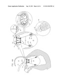 PROSTHETIC MITRAL VALVE WITH TISSUE ANCHORS diagram and image