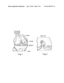 TWO PIECE CANCELLOUS CONSTRUCT FOR CARTILAGE REPAIR diagram and image