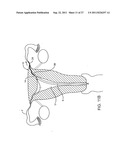 DEPLOYMENT ACTUATION SYSTEM FOR INTRAFALLOPIAN CONTRACEPTION diagram and image