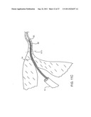 DEPLOYMENT ACTUATION SYSTEM FOR INTRAFALLOPIAN CONTRACEPTION diagram and image