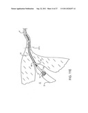 DEPLOYMENT ACTUATION SYSTEM FOR INTRAFALLOPIAN CONTRACEPTION diagram and image