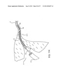 DEPLOYMENT ACTUATION SYSTEM FOR INTRAFALLOPIAN CONTRACEPTION diagram and image