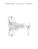 DEPLOYMENT ACTUATION SYSTEM FOR INTRAFALLOPIAN CONTRACEPTION diagram and image