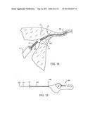 DEPLOYMENT ACTUATION SYSTEM FOR INTRAFALLOPIAN CONTRACEPTION diagram and image