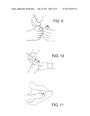 CREATION AND IMPLANTATION OF AN ARTIFICIAL NAIL FOR THE TREATMENT OF     DEFORMED OR MISSING NAILS diagram and image