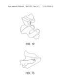 CREATION AND IMPLANTATION OF AN ARTIFICIAL NAIL FOR THE TREATMENT OF     DEFORMED OR MISSING NAILS diagram and image