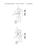 METHOD AND APPARATUS FOR DETECTION OF CARIES diagram and image