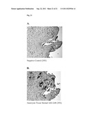 TREATMENT OF DISSECTION, ANEURYSM, AND ATHEROSCLEROSIS USING GRANZYME B     INHIBITORS diagram and image