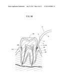 DENTAL LASER RADIATION CHIP diagram and image