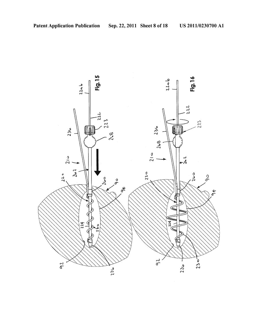 EXPANDABLE BRACHYTHERAPY APPARATUS AND METHODS FOR USING THEM - diagram, schematic, and image 09