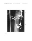 Bone Distraction System diagram and image