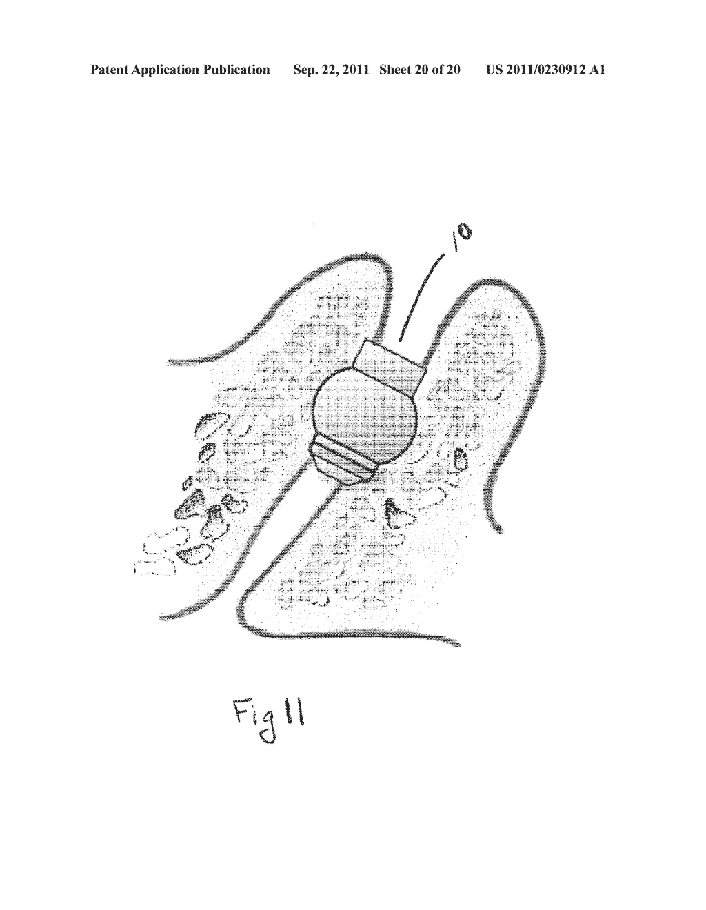 CORTICAL, ANTI-MIGRATION, FACET DOWEL FOR FUSION OF FACET JOINTS IN THE     SPINE AND DEVICES FOR SETTING THE SAME IN PLACE - diagram, schematic, and image 21