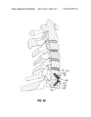 ANTERIOR BRACKET FOR SPINAL FIXATION diagram and image