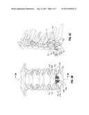 ANTERIOR BRACKET FOR SPINAL FIXATION diagram and image