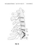 ANTERIOR BRACKET FOR SPINAL FIXATION diagram and image