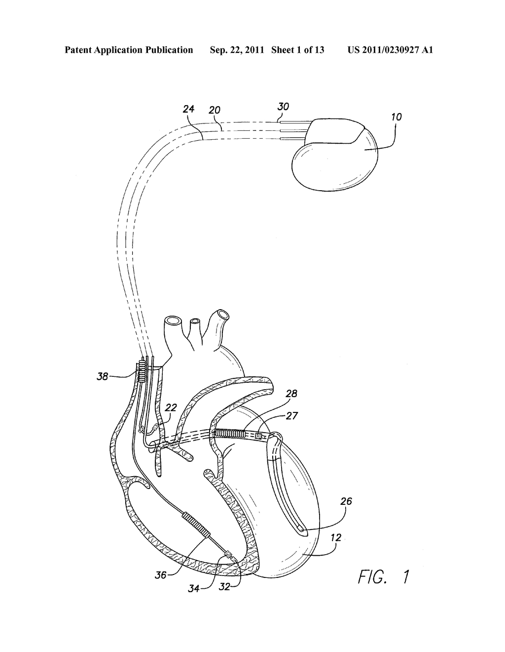 METHOD AND SYSTEM FOR DETECTING AND TREATING JUNCTIONAL RHYTHMS - diagram, schematic, and image 02