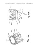 ENDOPROSTHESIS ASSEMBLIES AND METHODS FOR USING THE SAME diagram and image