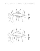 ENDOPROSTHESIS ASSEMBLIES AND METHODS FOR USING THE SAME diagram and image