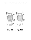 ENDOPROSTHESIS ASSEMBLIES AND METHODS FOR USING THE SAME diagram and image