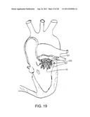 REPOSITIONABLE ENDOLUMINAL SUPPORT STRUCTURE AND ITS APPLICATIONS diagram and image