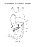 REPOSITIONABLE ENDOLUMINAL SUPPORT STRUCTURE AND ITS APPLICATIONS diagram and image