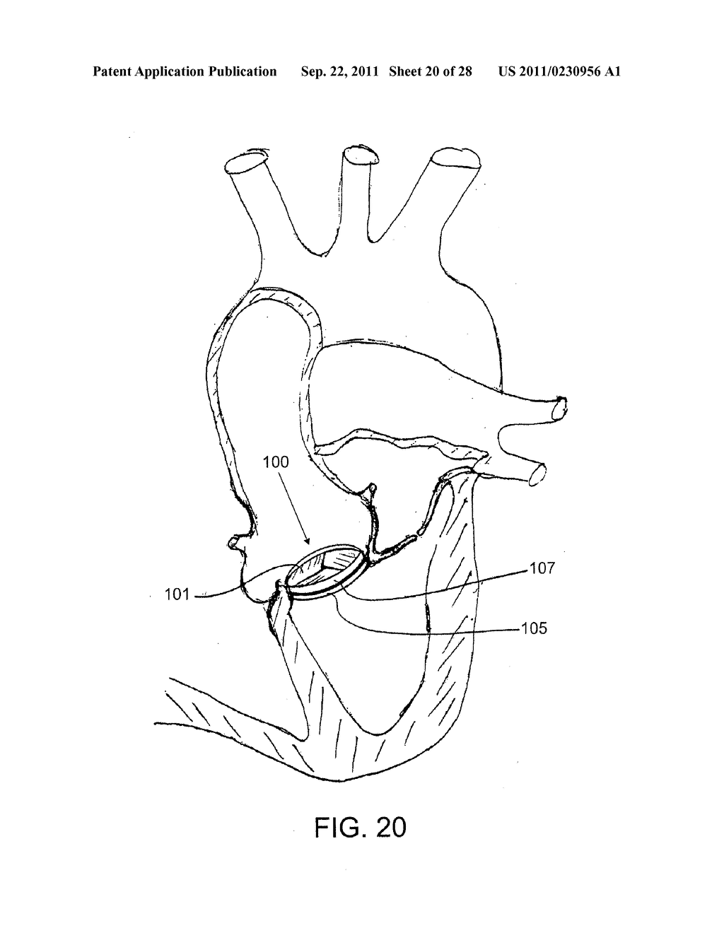 REPOSITIONABLE ENDOLUMINAL SUPPORT STRUCTURE AND ITS APPLICATIONS - diagram, schematic, and image 21