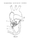 REPOSITIONABLE ENDOLUMINAL SUPPORT STRUCTURE AND ITS APPLICATIONS diagram and image