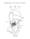 REPOSITIONABLE ENDOLUMINAL SUPPORT STRUCTURE AND ITS APPLICATIONS diagram and image