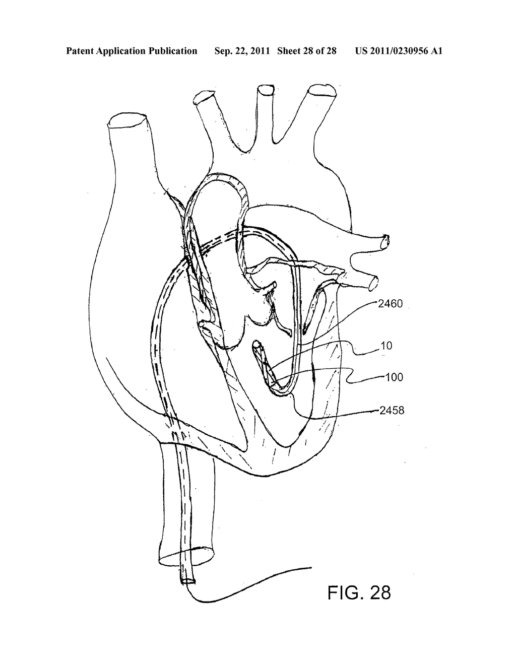 REPOSITIONABLE ENDOLUMINAL SUPPORT STRUCTURE AND ITS APPLICATIONS - diagram, schematic, and image 29